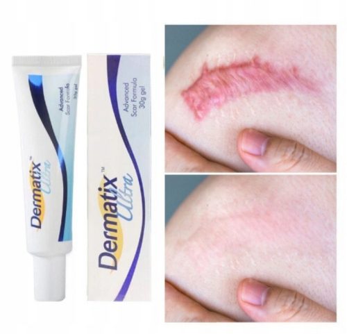 Dermatix Ultra Advanced Silicone Scar Treatment Gel, 15g - Smooth and Soften Scars
